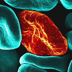 Malaria